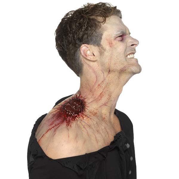 Infected Bite Wound Prosthetic